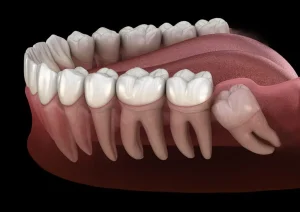 Advanced Wisdom Tooth Surgery