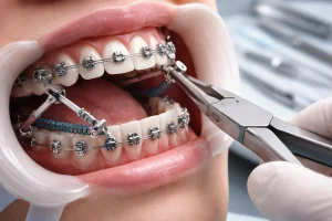Complex Orthodontic Cases