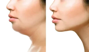 Jaw line corrections