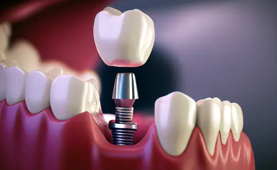 Implant Dentistry