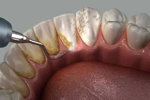 Periodontics